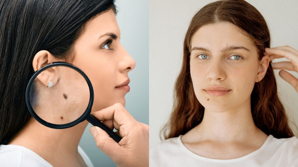 Mole-Astrology-Moles-on-the-Body-and-Their-Importance